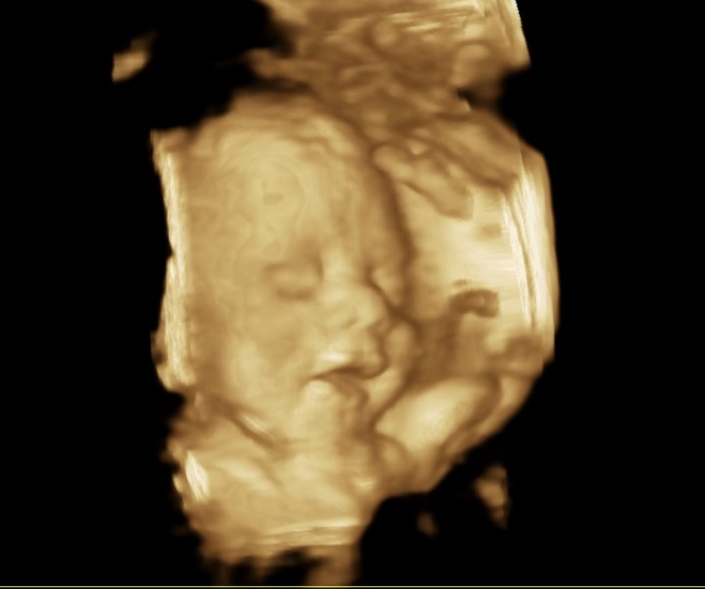 Ultrasound - Women for Women